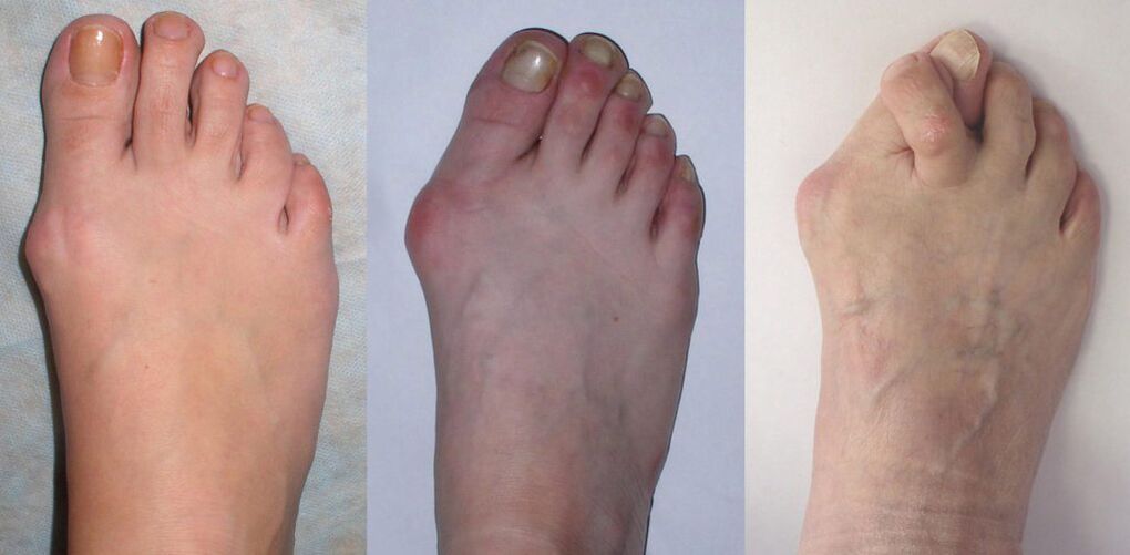 Arthritis foot