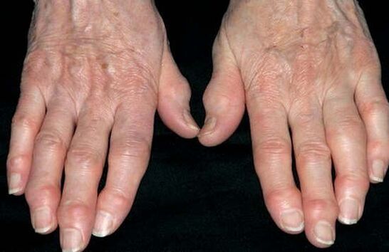 Arthrosis of hand