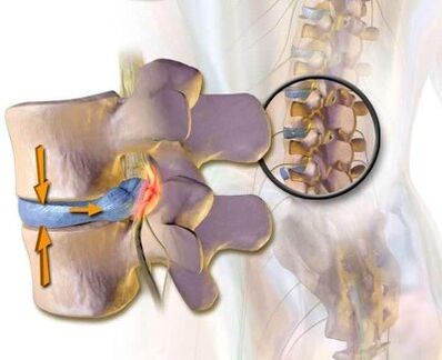 Vascular-brown syndrome