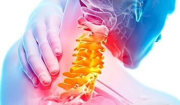 Signs of osteochondrose cervical spine