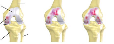 degree of arthrosis