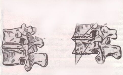 The intervertebral disk is healthy and with lumbar osteochondrose