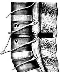 X -Ray Picture of the lumbar department about Otoohondrazi