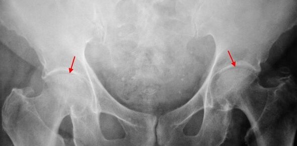 Double-sided coxartrosis-sustling of common gap, sclerosis of articulated surfaces