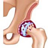Hook's wrist arthrosis