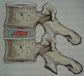 The first stage of osteochondrosis